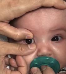Fingers removing a contact lens from a baby's eye