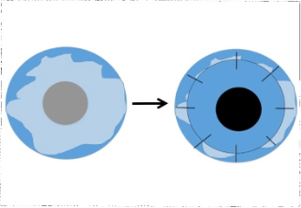 Penetrating Keratoplasty diagram front view in blue and black