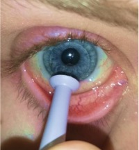 Person holding open their eye, using a device to remove a contact lens