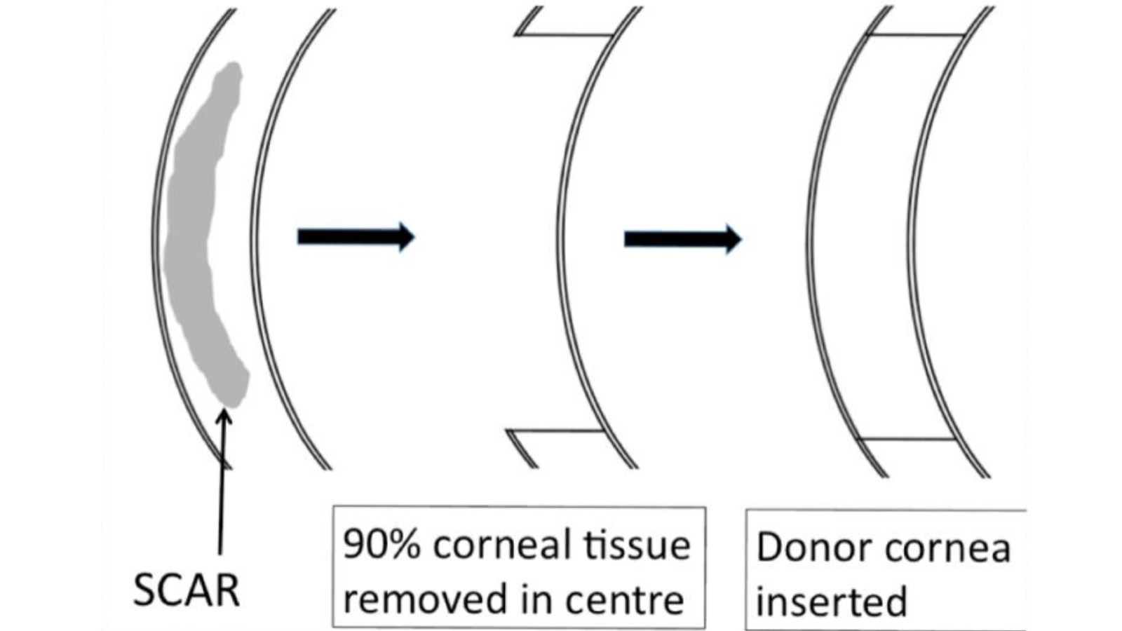 Diagram of deep anterior lamellar keratoplasty 