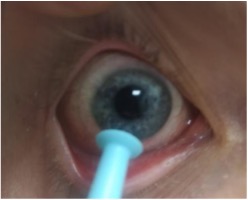 Eye being opened wide and a contact lens is being removed with a blue device.