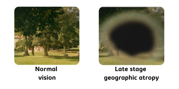 Normal vision compared to late stage geographic atrophy