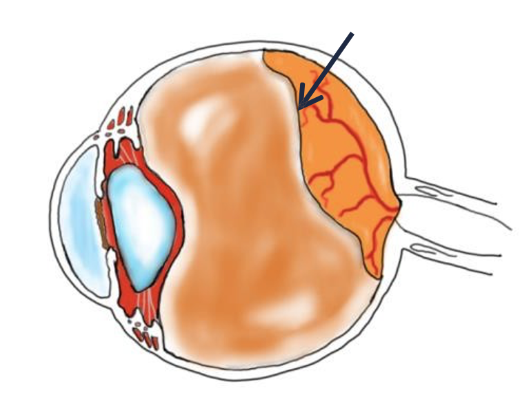 Colour diagram of a Posterior vitreous detachment