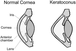 Black and white diagram of a normal cornea and a Keratoconus Cornea