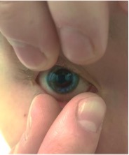 Fingers above and below an eye removing a contact lens