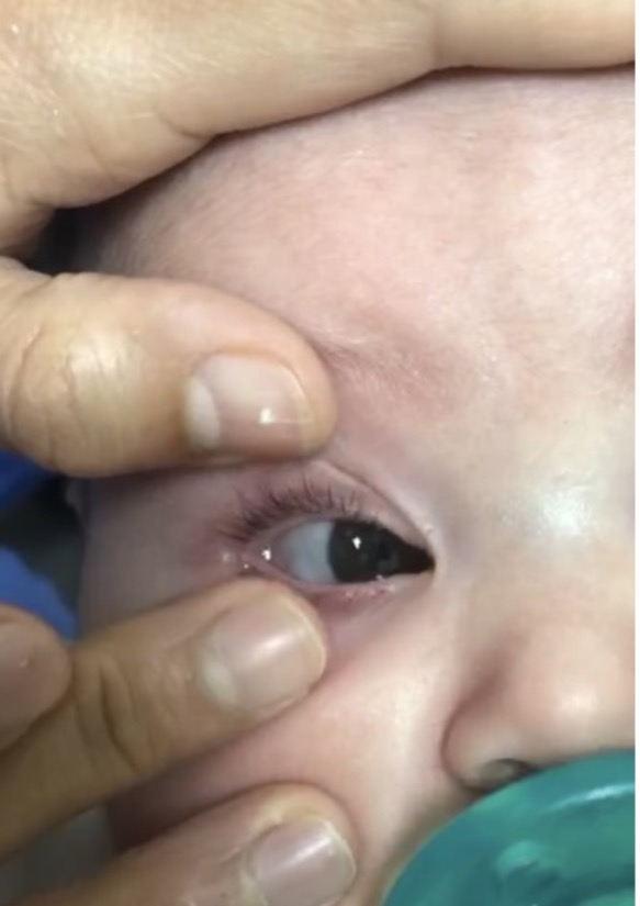 Fingers placing a contact lens on a baby's eye