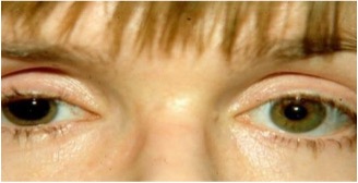 Image of dilated eye with a large pupil after eye drop application