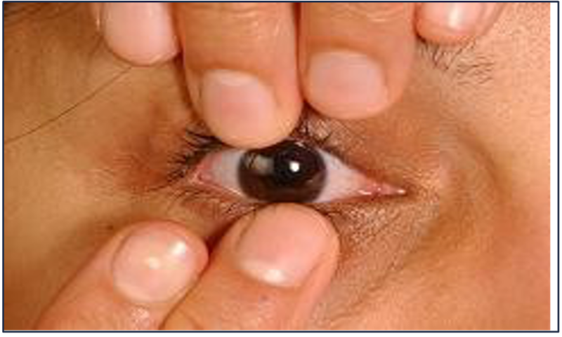 Fingers above and below an eye to remove a contact lens