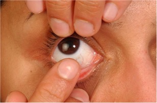 Finders removing a contact lens from an eye