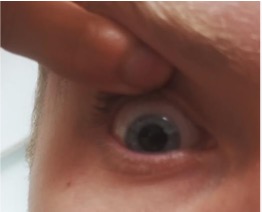 Finger pressing on the top eyelid of an eye