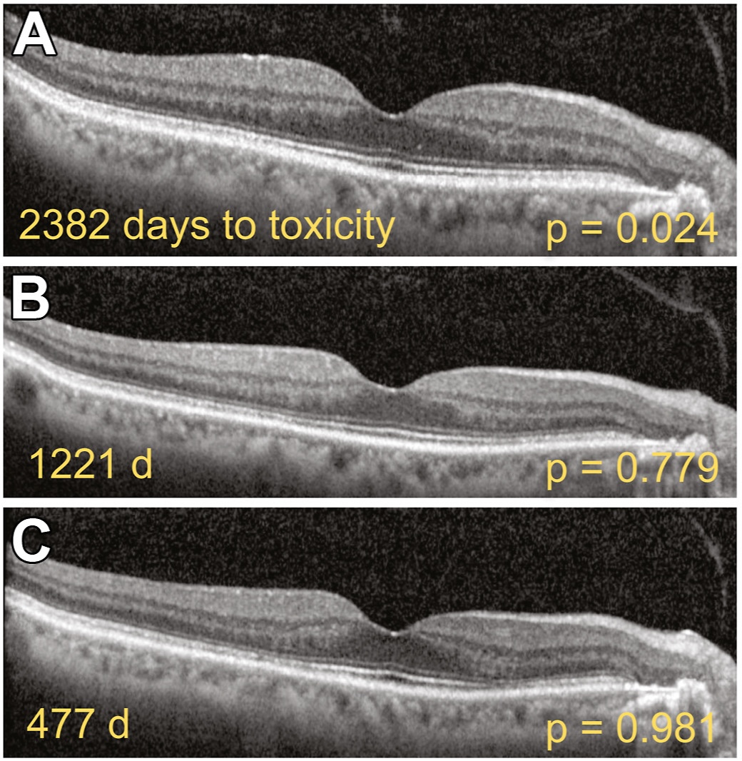 AI Prediction Of HCQ Retinopathy