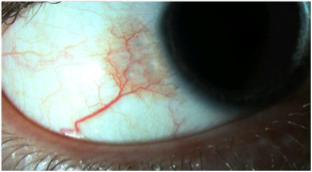 Image of Naevus with no pigment