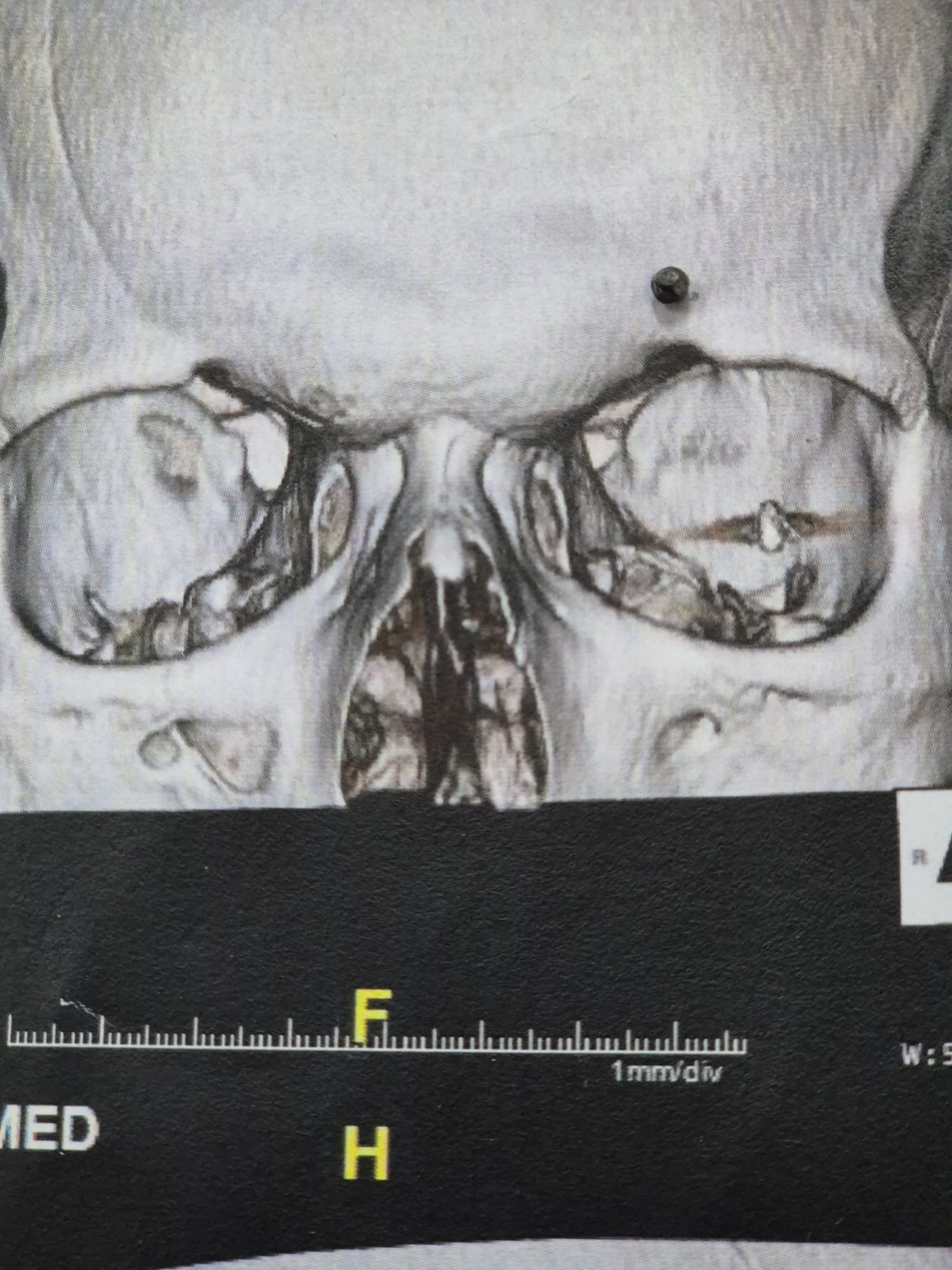 Photo of an X-ray image of bullet